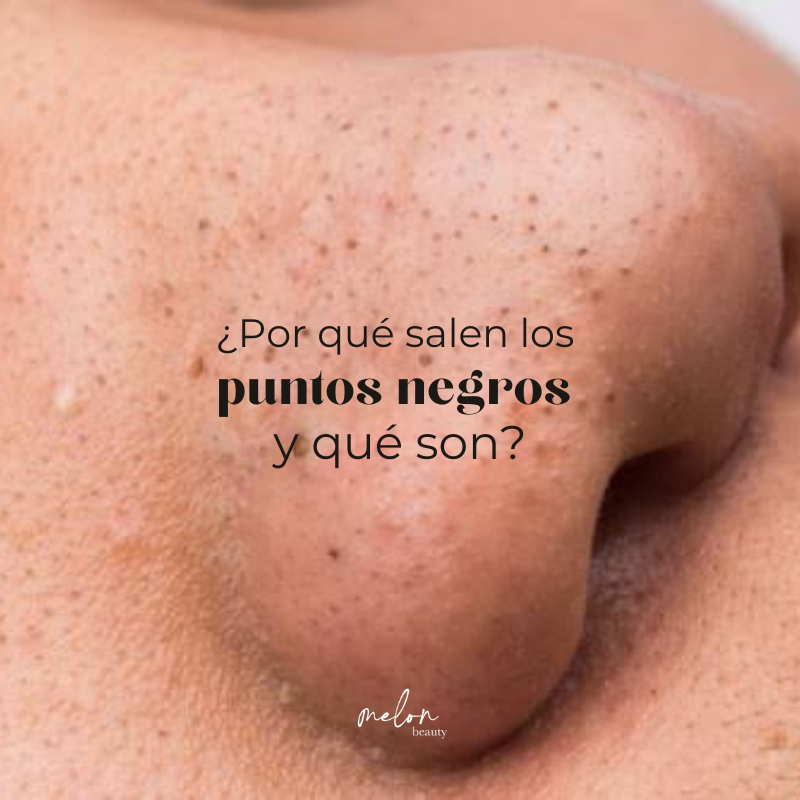 ¿Por qué salen los Puntos Negros y qué son?