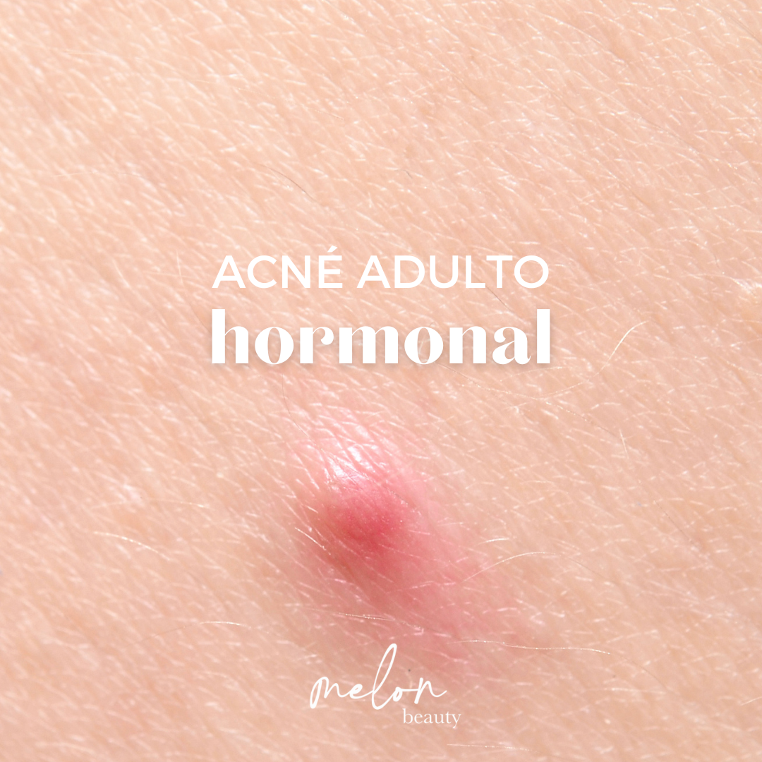 Acné Adulto Hormonal